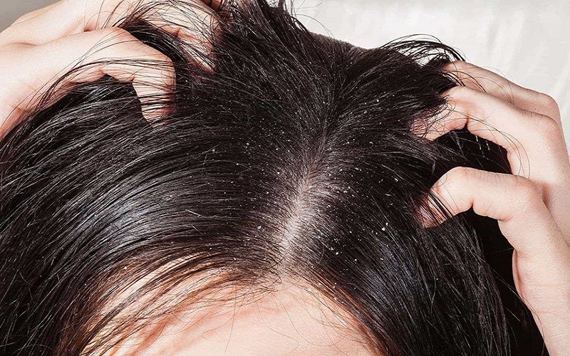 Nguyên nhân nào gây ra nấm da đầu?