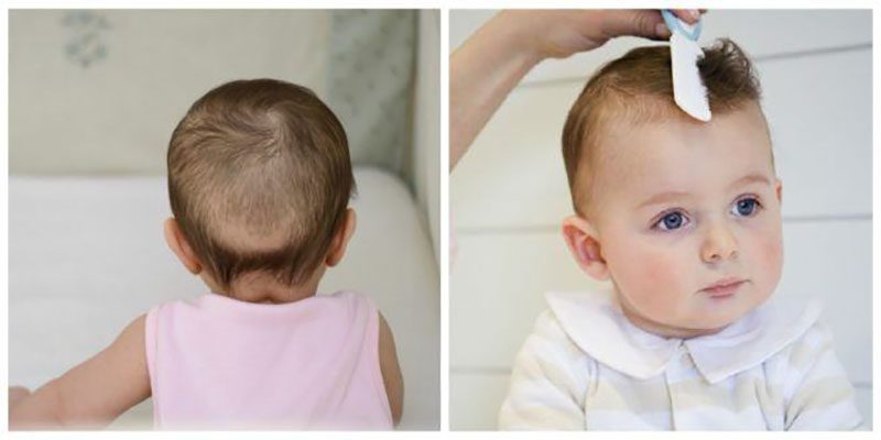 Trẻ 3 tháng bị rụng tóc có sao không?
