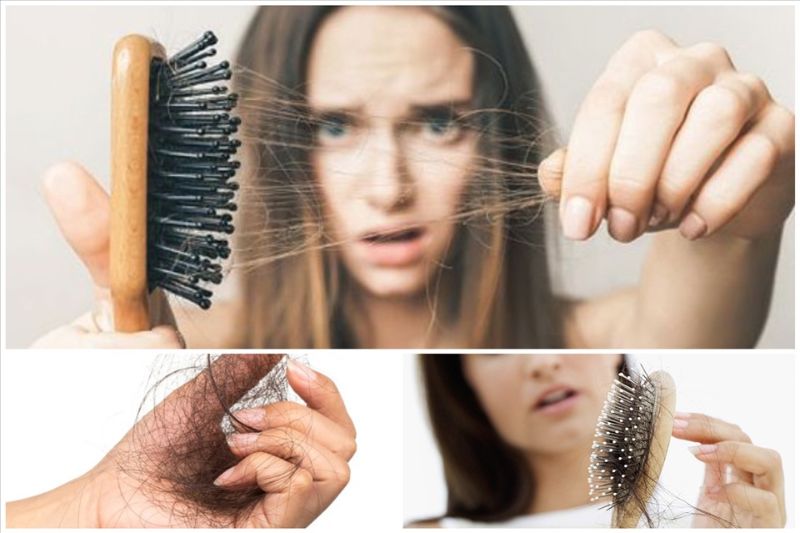 Bệnh rụng tóc không chỉ xuất hiện ở nữ mà còn có ở nam giới