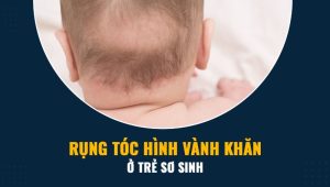 Rụng tóc vành khăn ở trẻ nhỏ - Nguyên nhân do đâu?