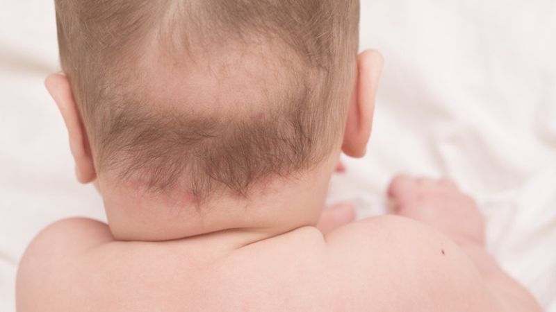Việc thiếu hụt các chất dinh dưỡng cũng có thể gây rụng tóc ở trẻ
