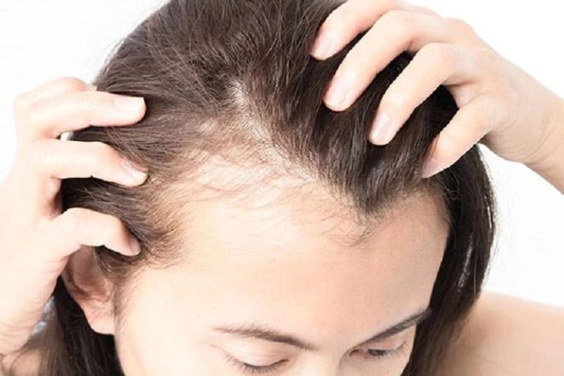 Thiếu canxi là một trong những nguyên nhân gây ra rụng tóc