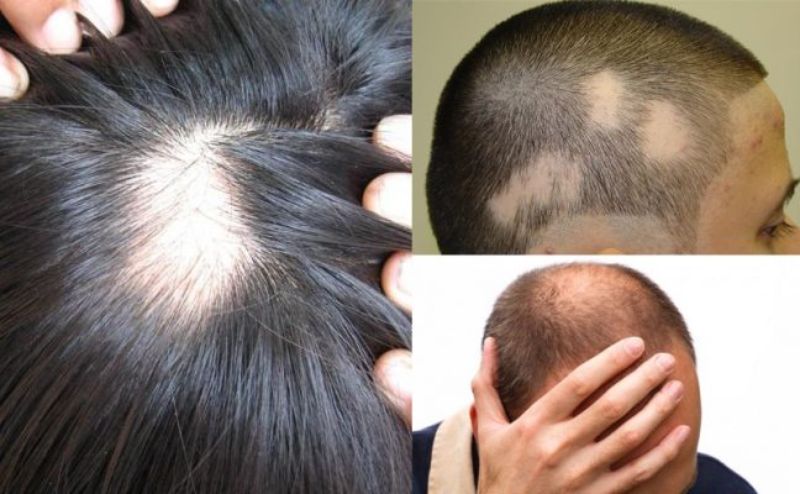 Rụng tóc pelade là tình trạng tóc rụng thành từng mảng 