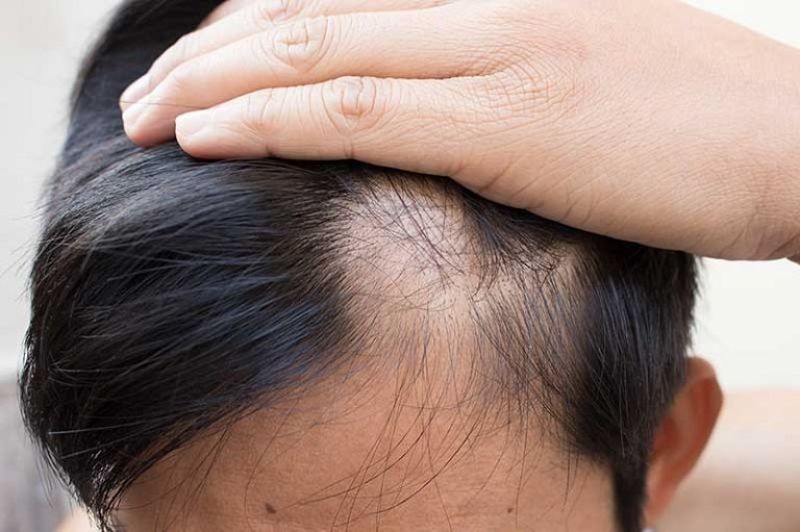 Có nhiều nguyên nhân dẫn đến rụng tóc pelade