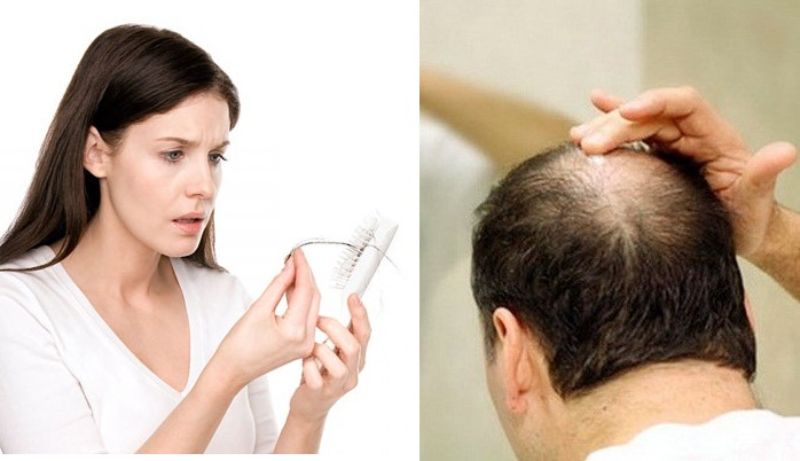 Những cách chữa rụng tóc pelade hiệu quả hiện nay