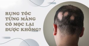 Rụng tóc từng mảng có mọc lại được không?