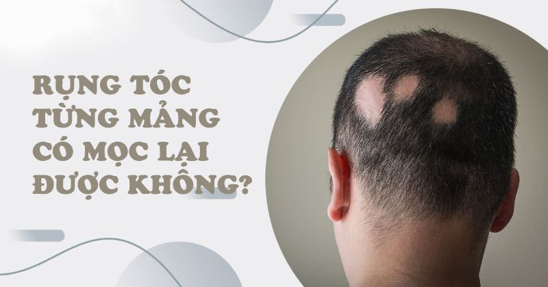 Rụng tóc từng mảng có mọc lại được không?