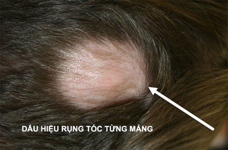 Dấu hiệu nhận biết tóc rụng theo từng mảng 
