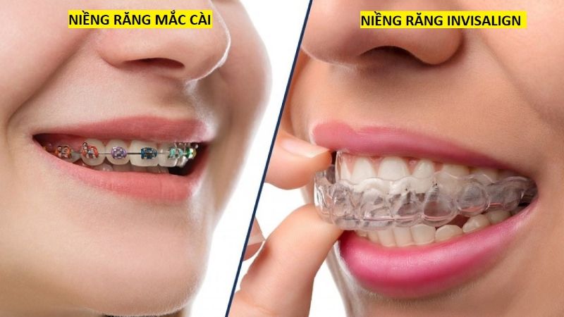 Niềng răng ở Cần Thơ