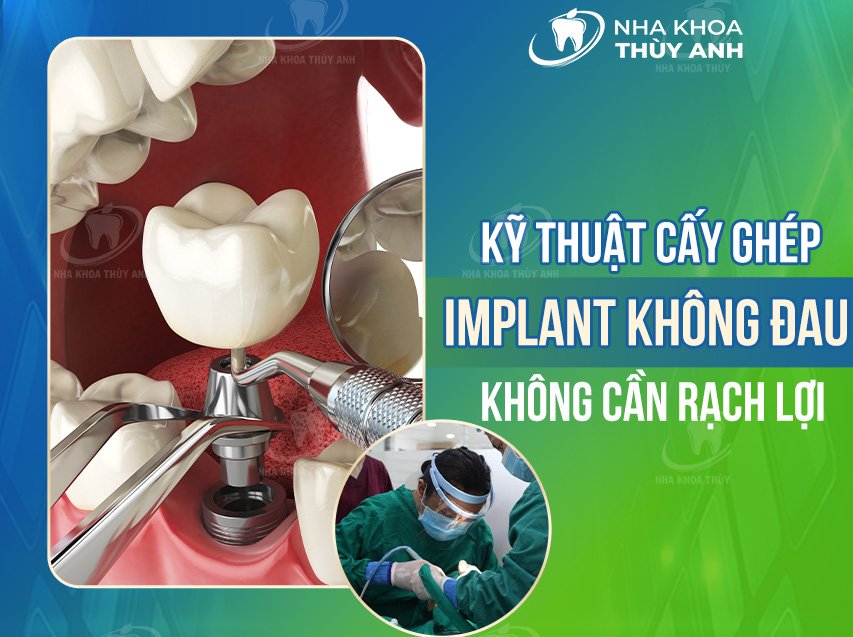 ky thuat cay ghep implant 2 1