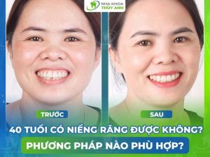 40 tuoi co nieng rang duoc khong phuong phap nao phu hop 768x576 1 1