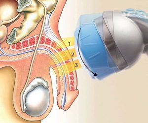 eswt treatment 1 0 1