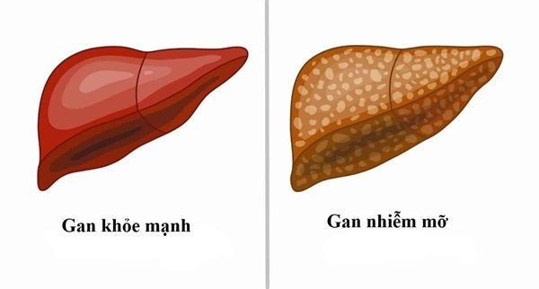 Bệnh gan nhiễm mỡ là một trong số những bệnh tiềm ẩn nhiều nguy hiểm