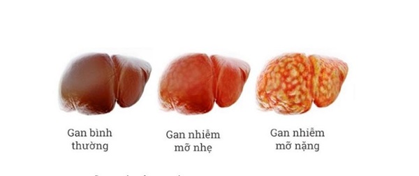 Gan nhiễm mỡ có thể gây ung thư